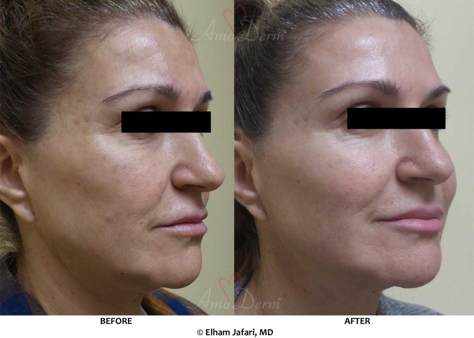 Liquid Facelift