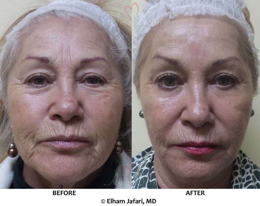 Liquid Facelift - Before &amp; After Gallery Real Results at Amoderm