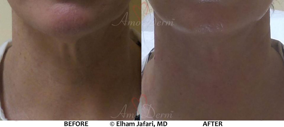 Neck Rejuvenation - Before &amp; After Gallery Real Results at Amoderm