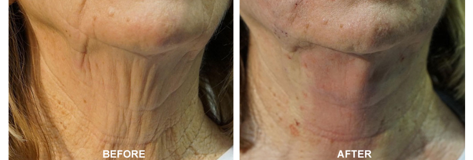 PDO Threading and Neck Rejuvenation