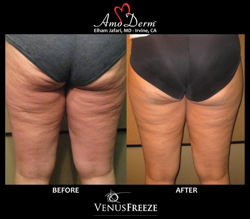 Body Contouring and Cellulite Treatment