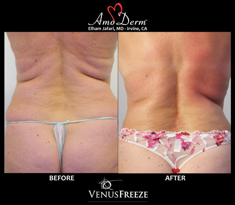 Body contouring and cellulite treatment with Venus Freeze