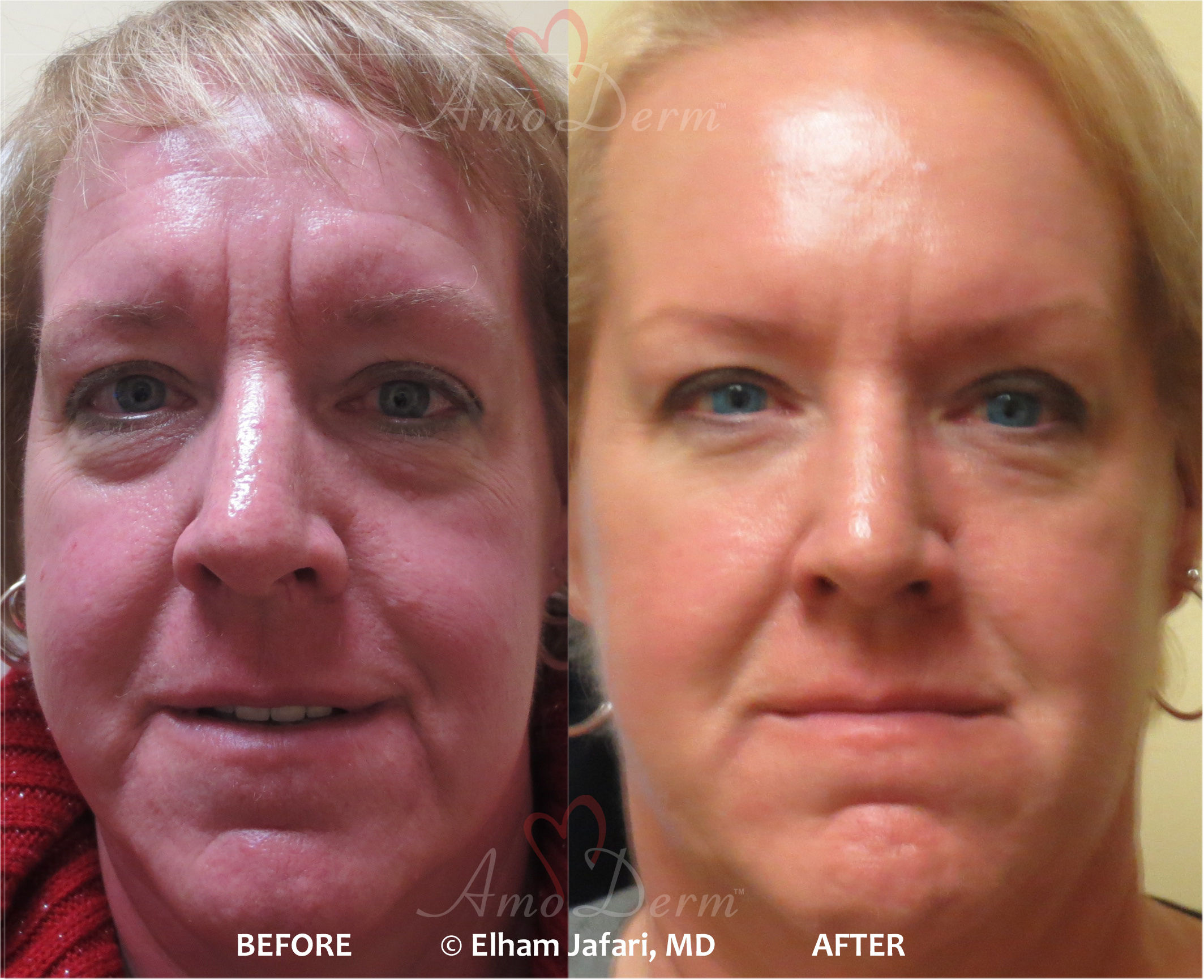 Liquid facelift with fillers and Botox