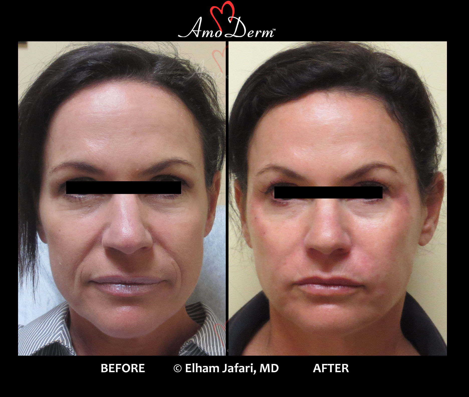 Whole-face rejuvenation (Liquid FaceLift) with dermal filler injection