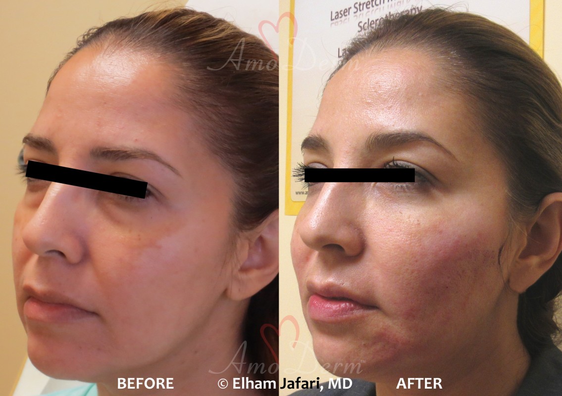 Bellafill dermal fillers injection before and after pictures