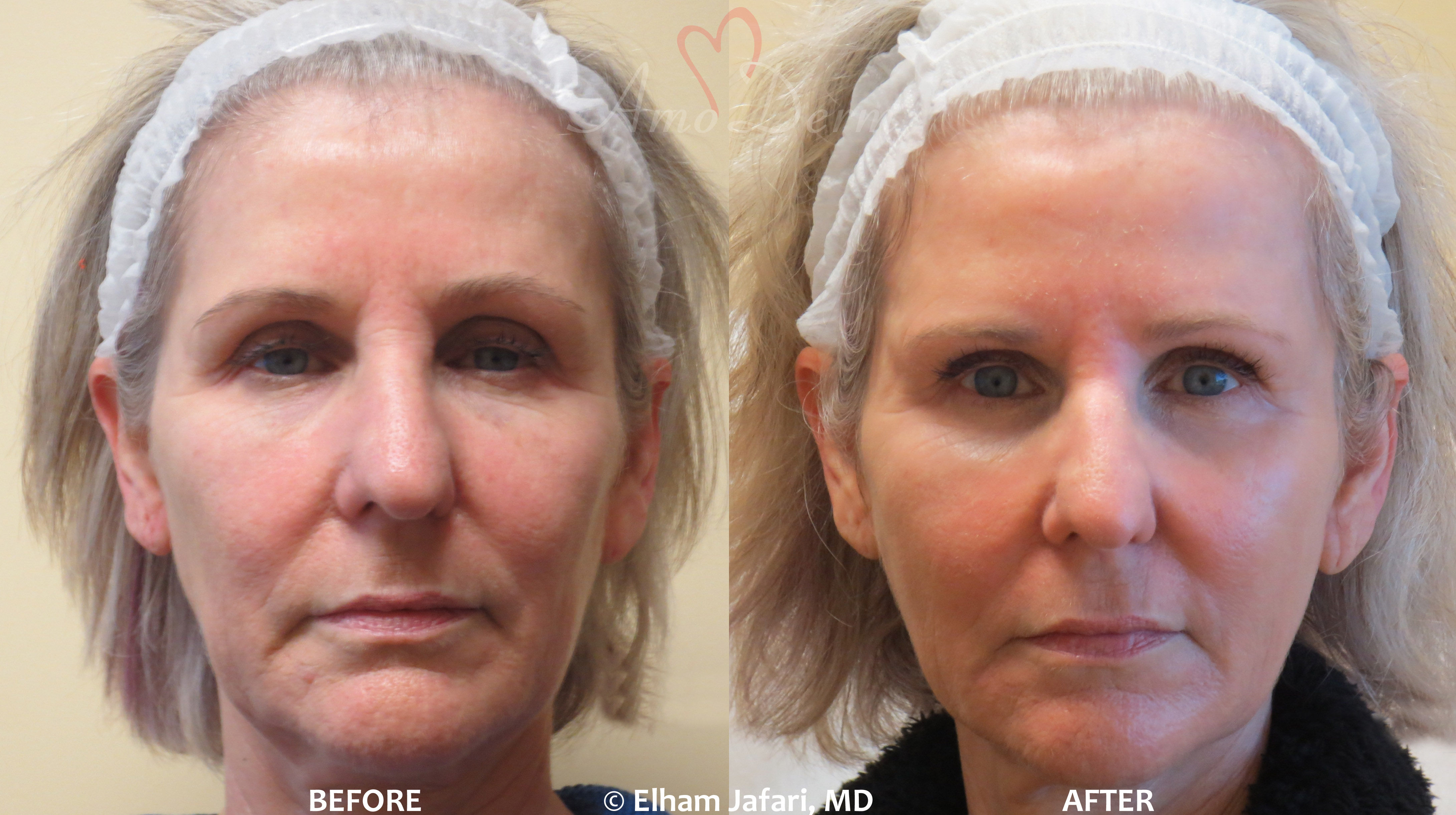 Surgical Facelift or Liquid Facelift - Before and After pictures