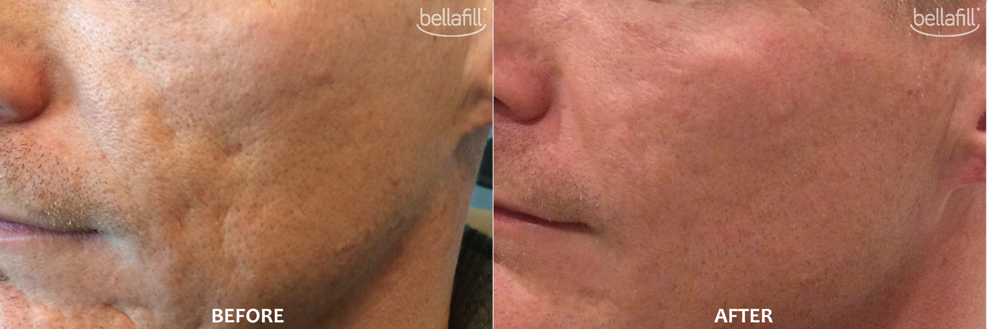 Bellafill Acne Before and After