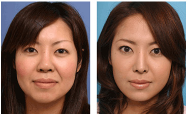 Botox for Facial Slimming