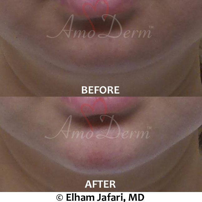 Dermal fillers like bellafill, radiesse or juvederm voluma for chin augmentation treatment real pacients before and after pictures