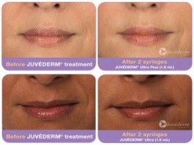 Juvederm treatments in Orange County