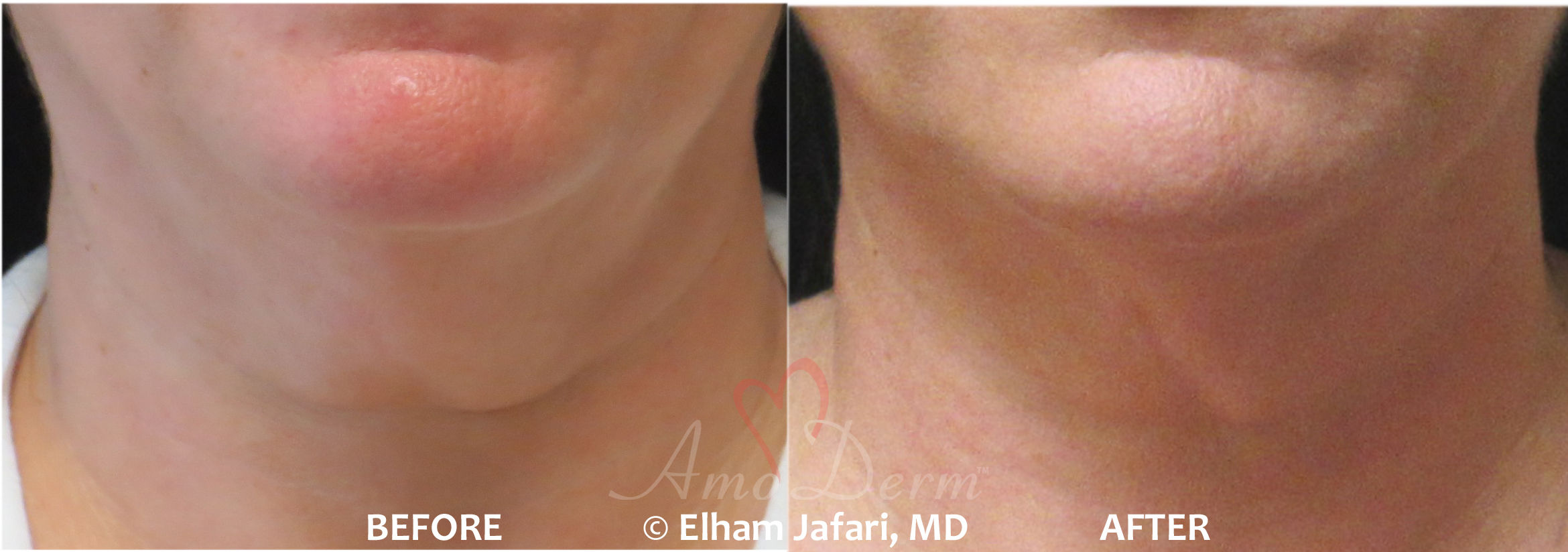 Kybella Injection for Neck- Before and After Pictures