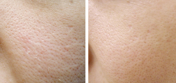 Enlarged pores, clogged pores and treatments to reduce them