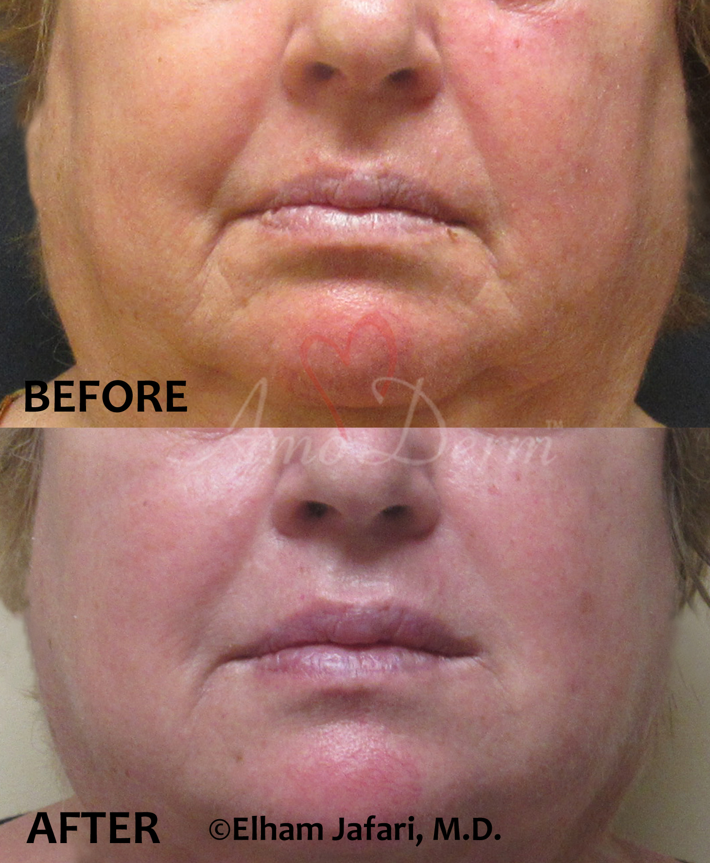 Cosmetic treatment for marionette lines wrinkles with dermal filler by doctor Jafari at Amoderm