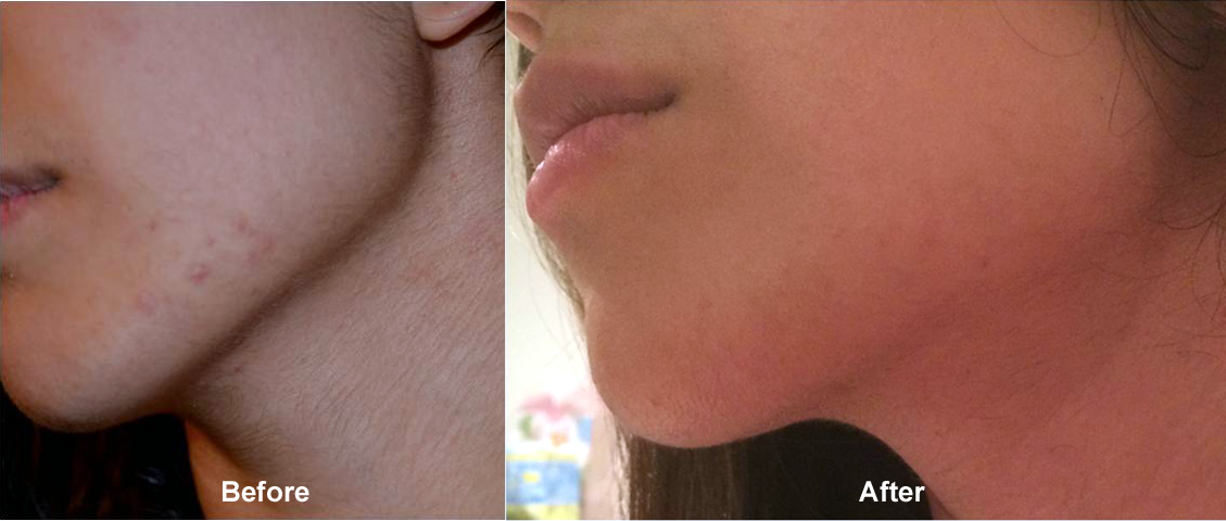 Micro Needling - Before and After Cosmetic Treatments pictures