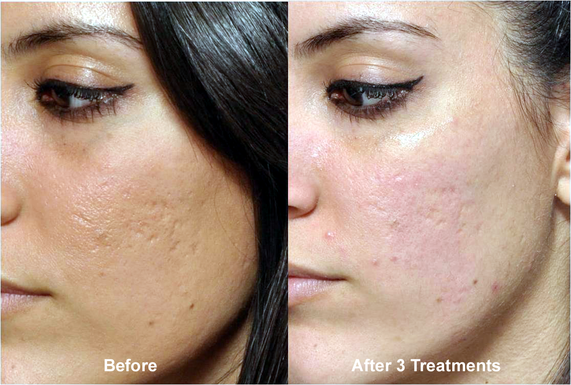 Microneedling Before and After treatment