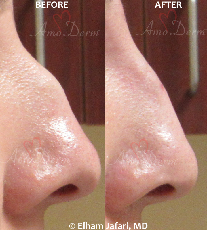 Non-surgical Nose Job Cosmetic Treatments Before and After Pictures