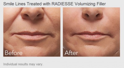 Smile Lines treated with Radiesse Volumizing Filler - Before and After Photos