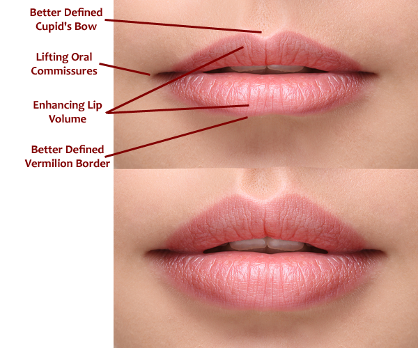 Areas to use Volbella, lips